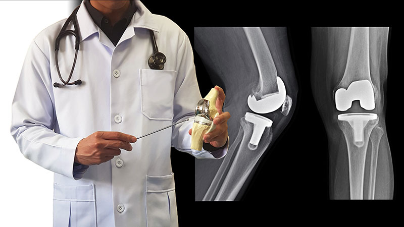 Behandlung bei Arthrose: Operation Behandlung bei Arthrose: Operation